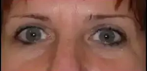 Tampa Eyelid and Orbital Surgery by Dr Kwitko
