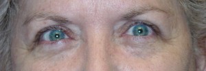 Post-Op Reconstructive Eyelid Surgery by Dr Kwitko