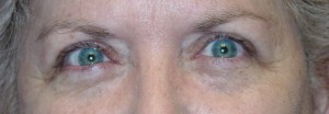 Ptosis After Picture Ptosis After Picture