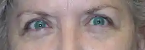 Post-Op Reconstructive Eyelid Surgery by Dr Kwitko