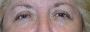 Ptosis Before Picture Ptosis Before Picture
