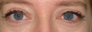 Post-op Thyroid Eyelid Surgery by Dr Kwitko 2