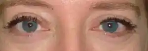 Post-op Thyroid Eyelid Surgery by Dr Kwitko 2