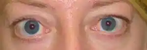 Pre Thyroid Eyelid Surgery by Dr Kwitko