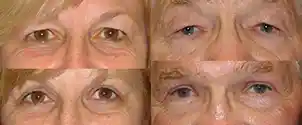Blepharoplasty Image Gallery