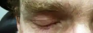 Post-op Reconstructive Eyelid Surgery by Dr Kwitko