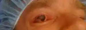 Reconstructive Eyelid Surgery by Dr Kwitko