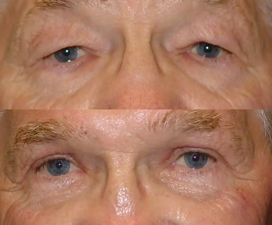 Blepharoplasty Gallery
