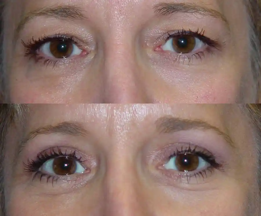 Blepharoplasty Gallery