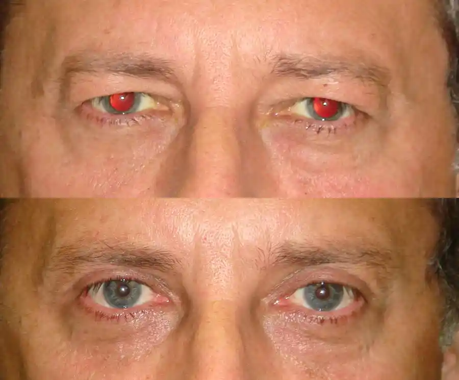 Blepharoplasty Gallery