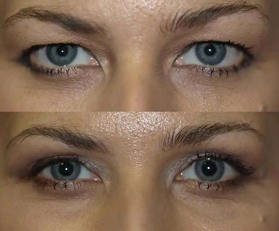 Blepharoplasty Gallery