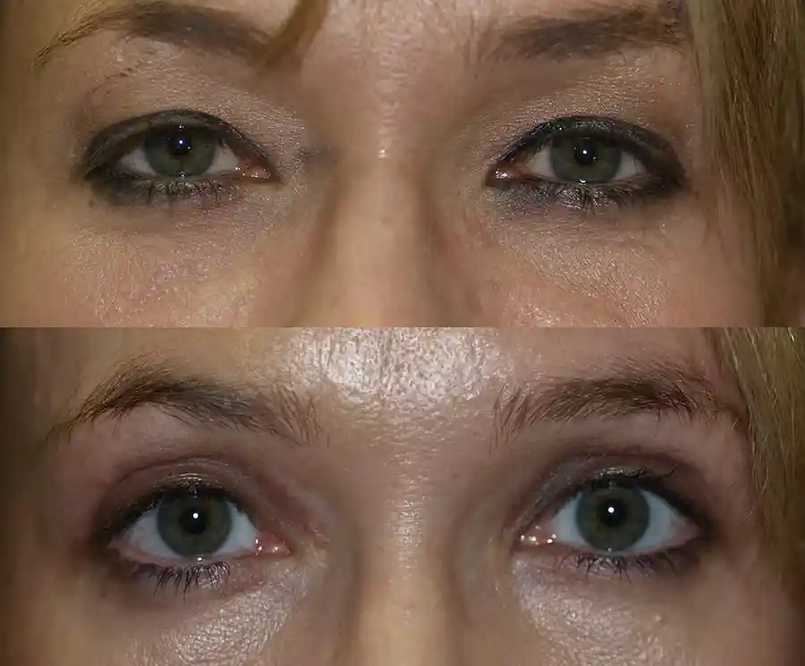 Blepharoplasty Gallery
