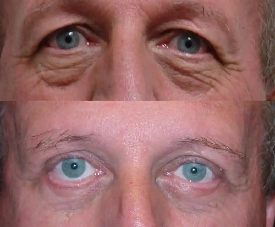 Blepharoplasty Gallery