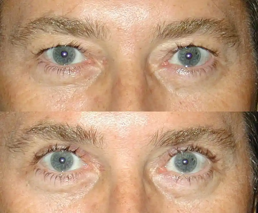 Blepharoplasty Gallery