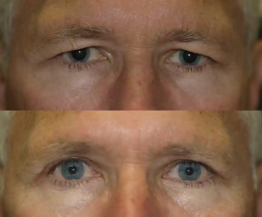 Blepharoplasty Gallery