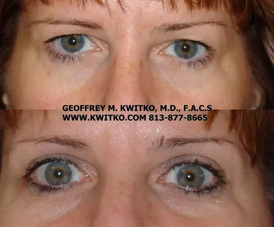 Blepharoplasty Gallery