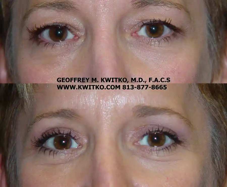 Blepharoplasty Gallery