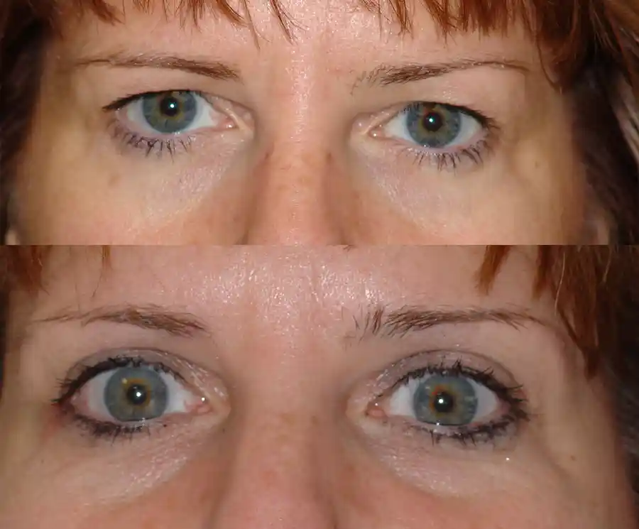 Cosmetic Eyelid Surgery