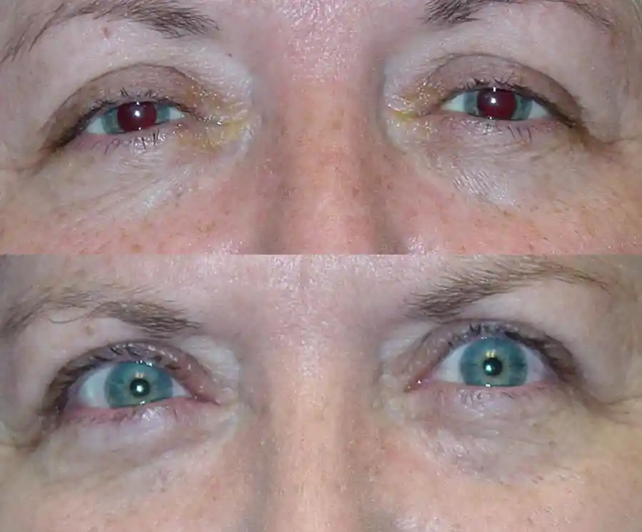 Ptosis Surgery