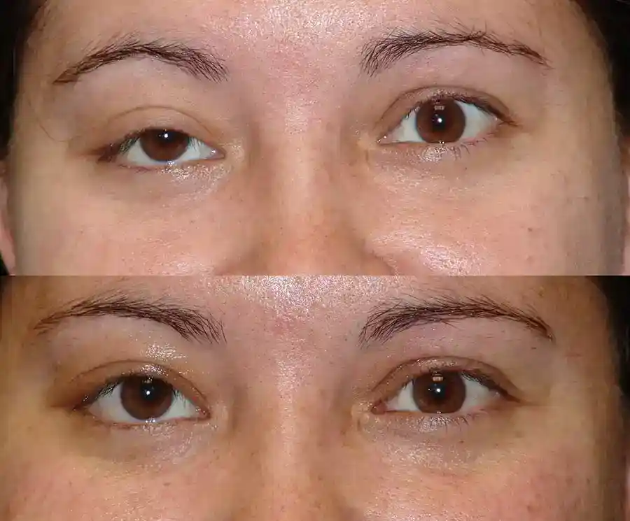Ptosis Surgery