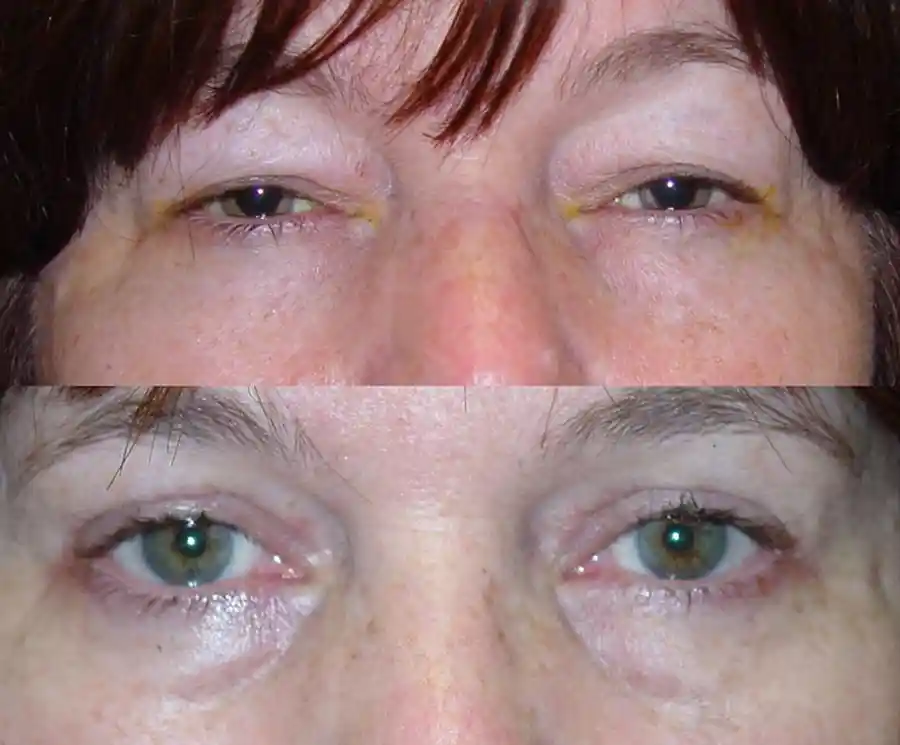 Ptosis Surgery