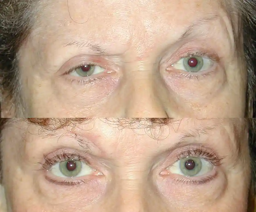 Ptosis Surgery