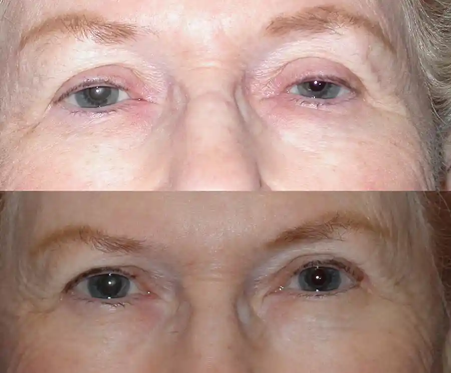 Ptosis Surgery