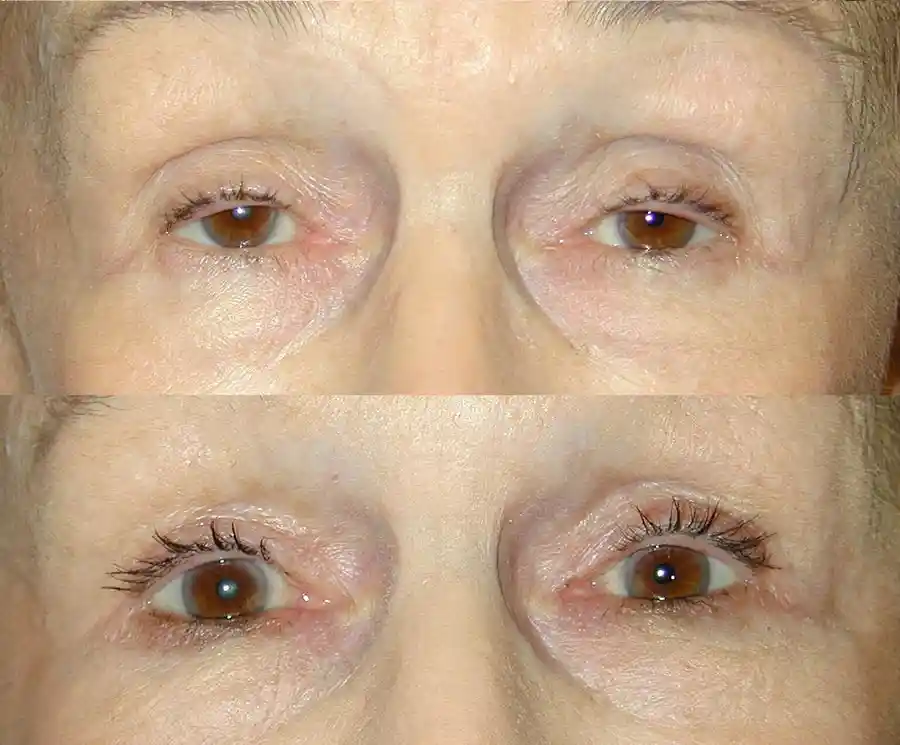 Ptosis Surgery