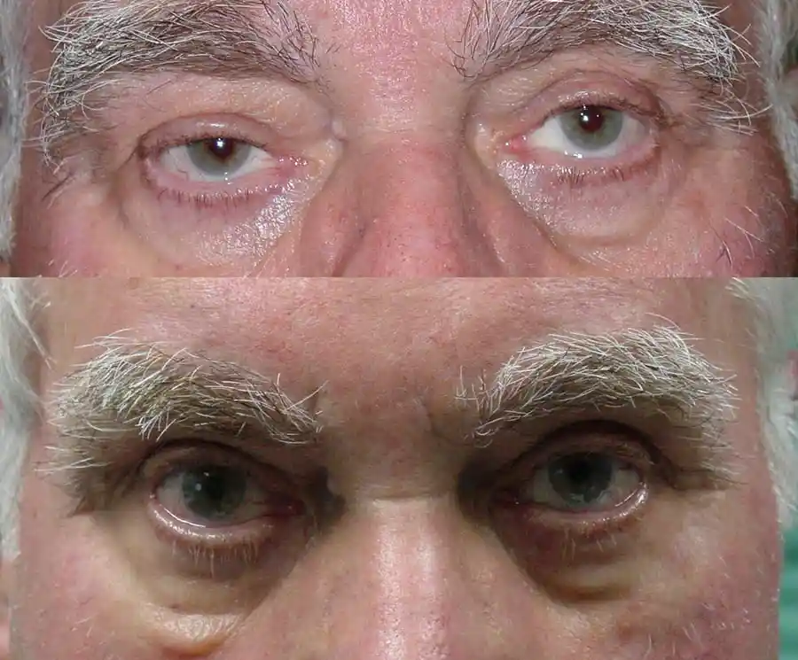 Ptosis Surgery