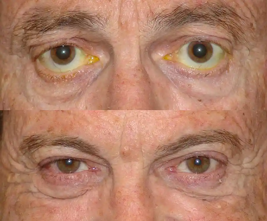 Thyroid Eyelid Surgery