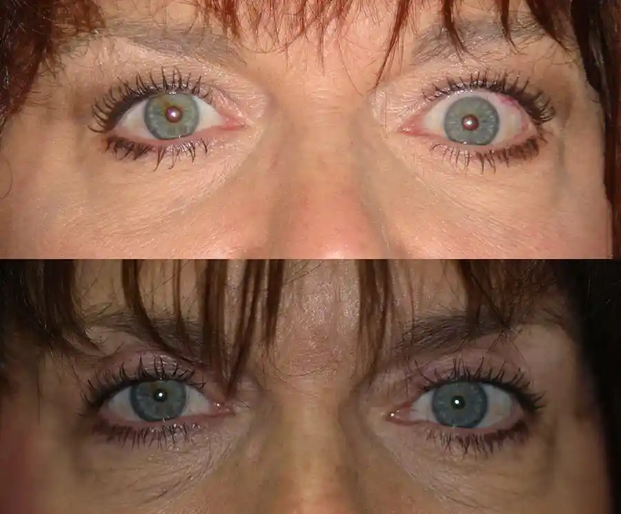 Thyroid Eyelid Surgery