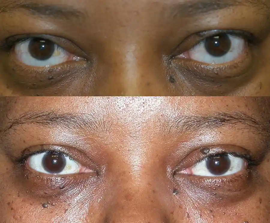 Thyroid Eyelid Surgery
