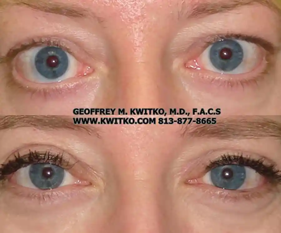 Thyroid Eyelid Surgery