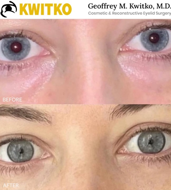 Lower Blepharoplasty