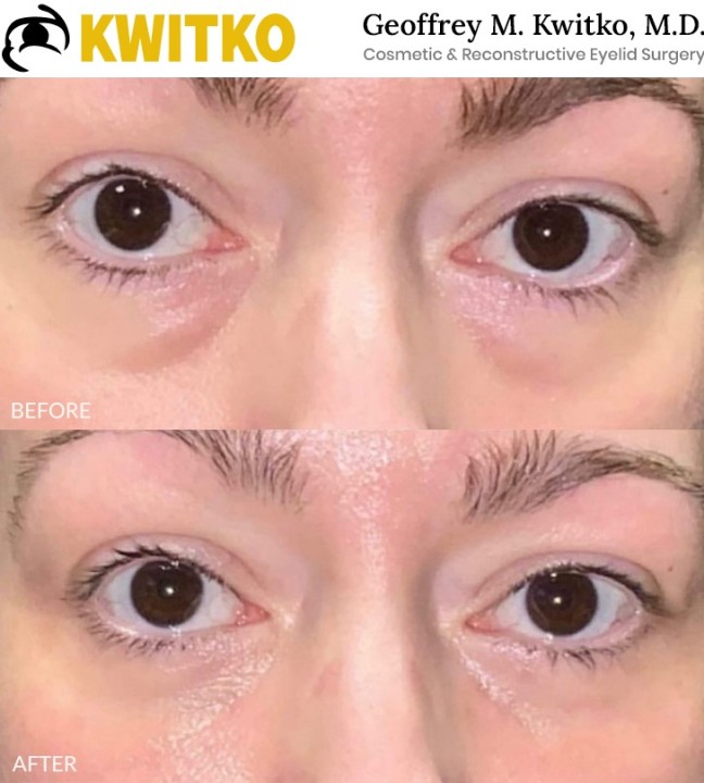 Lower Blepharoplasty