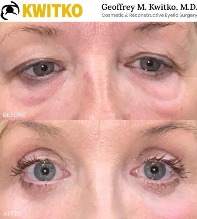 Lower Blepharoplasty