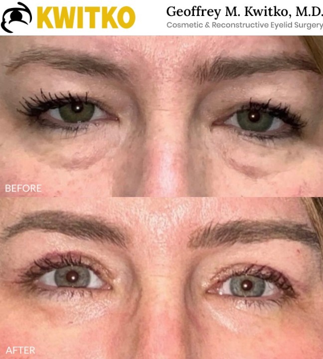 Lower Blepharoplasty