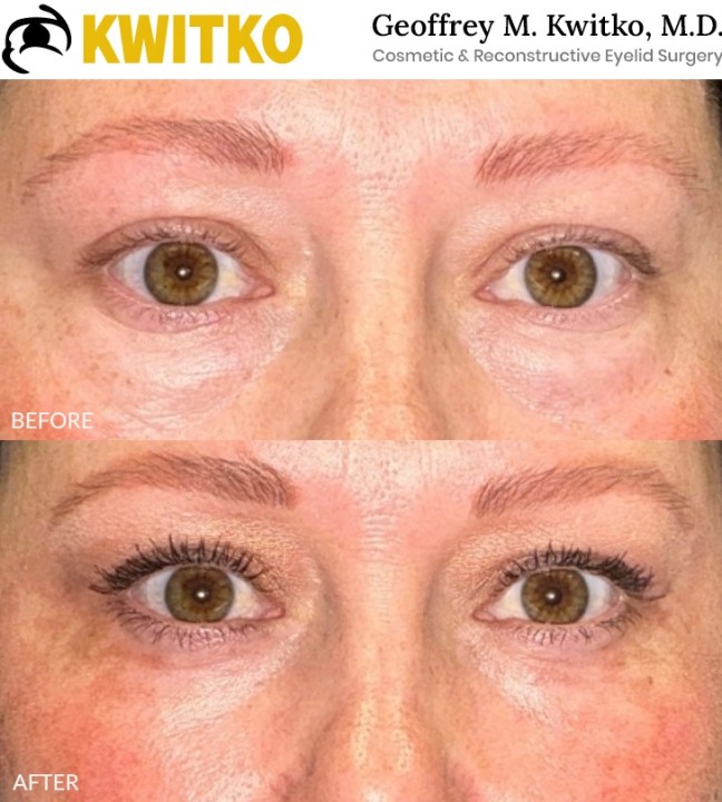 Lower Blepharoplasty