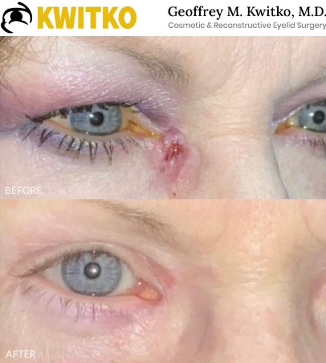 Reconstructive Eyelid Surgery
