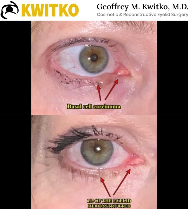 Reconstructive Eyelid Surgery