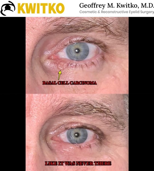 Reconstructive Eyelid Surgery
