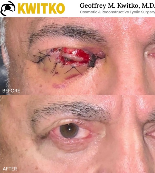 Reconstructive Eyelid Surgery
