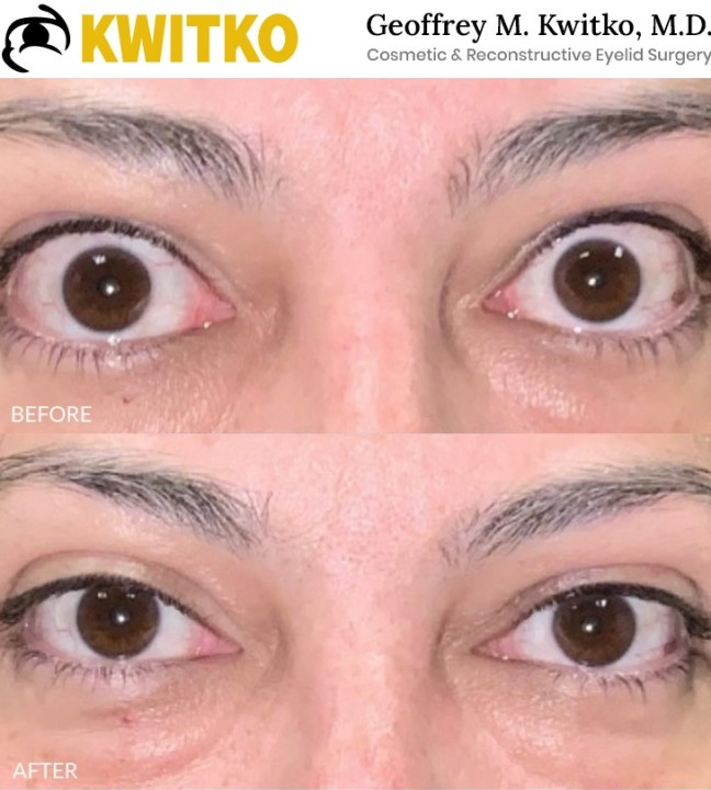 Thyroid Eyelid Surgery