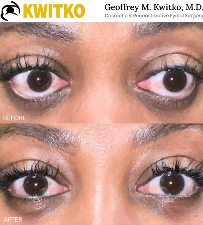 Thyroid Eyelid Surgery