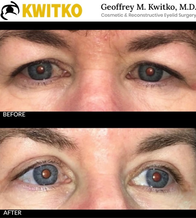 Upper Blepharoplasty