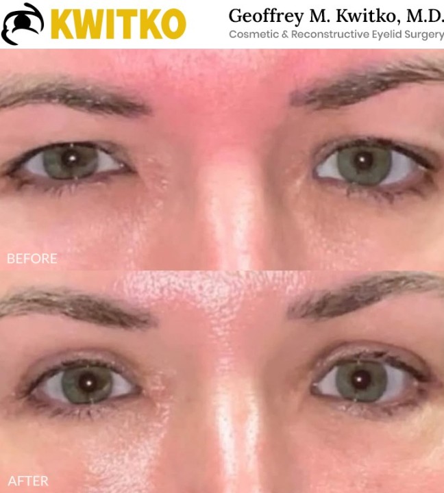 Upper Blepharoplasty