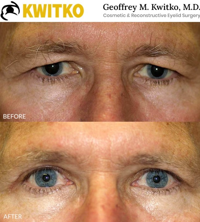 Upper Blepharoplasty