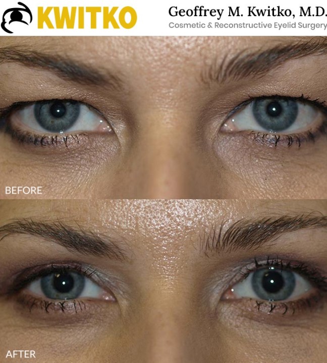 Upper Blepharoplasty