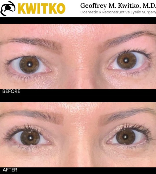 Upper Blepharoplasty