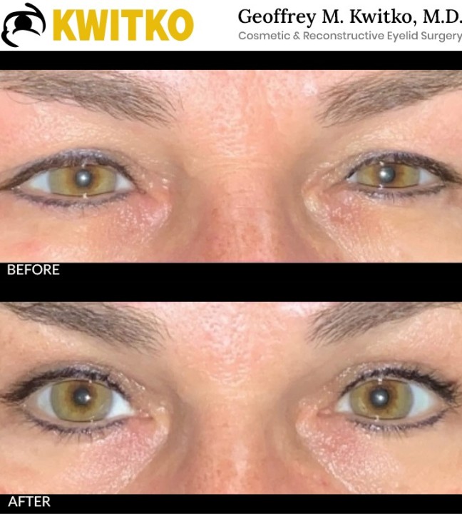 Upper Blepharoplasty